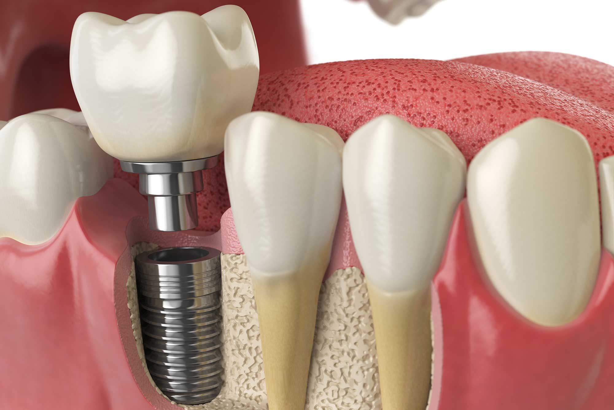 Dental implant Service