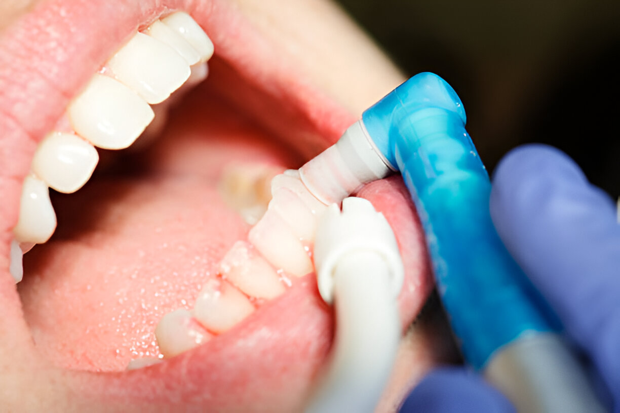 dental cleaning process